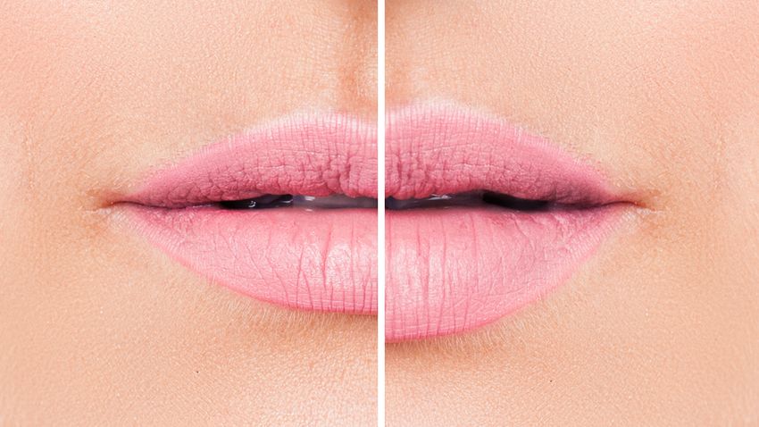 How much do lip injections cost in NYC